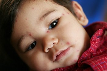 Mercy Grace Blog - Chickenpox
