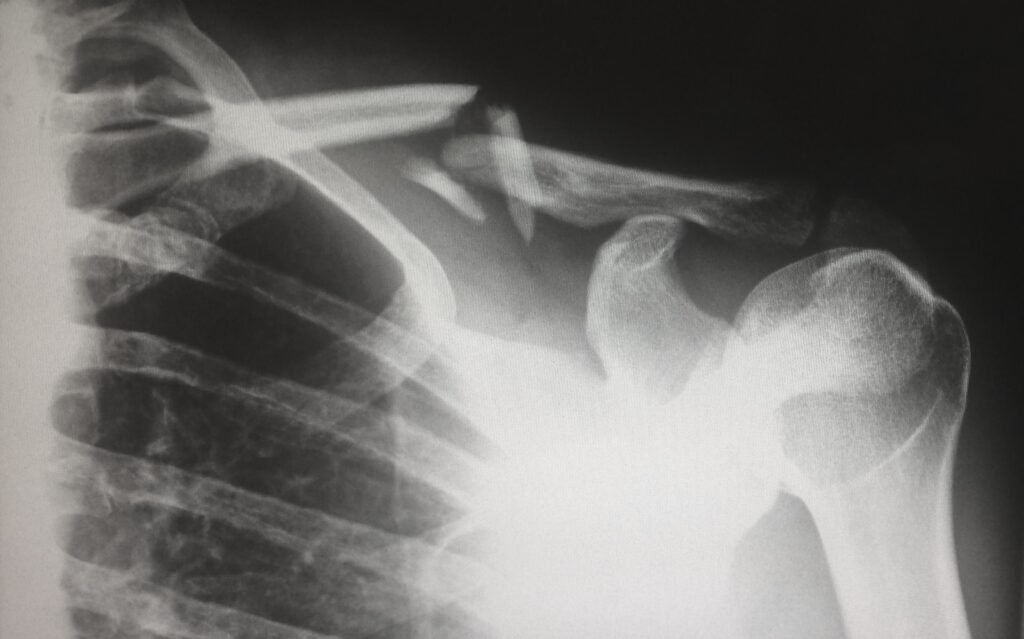Mercy Grace Blog - Broken Bones