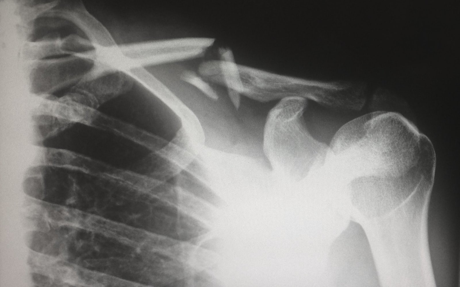 Mercy Grace Blog - Broken Bones